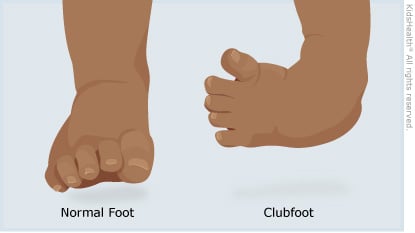 Clubfoot Cook Children S clubfoot cook children s